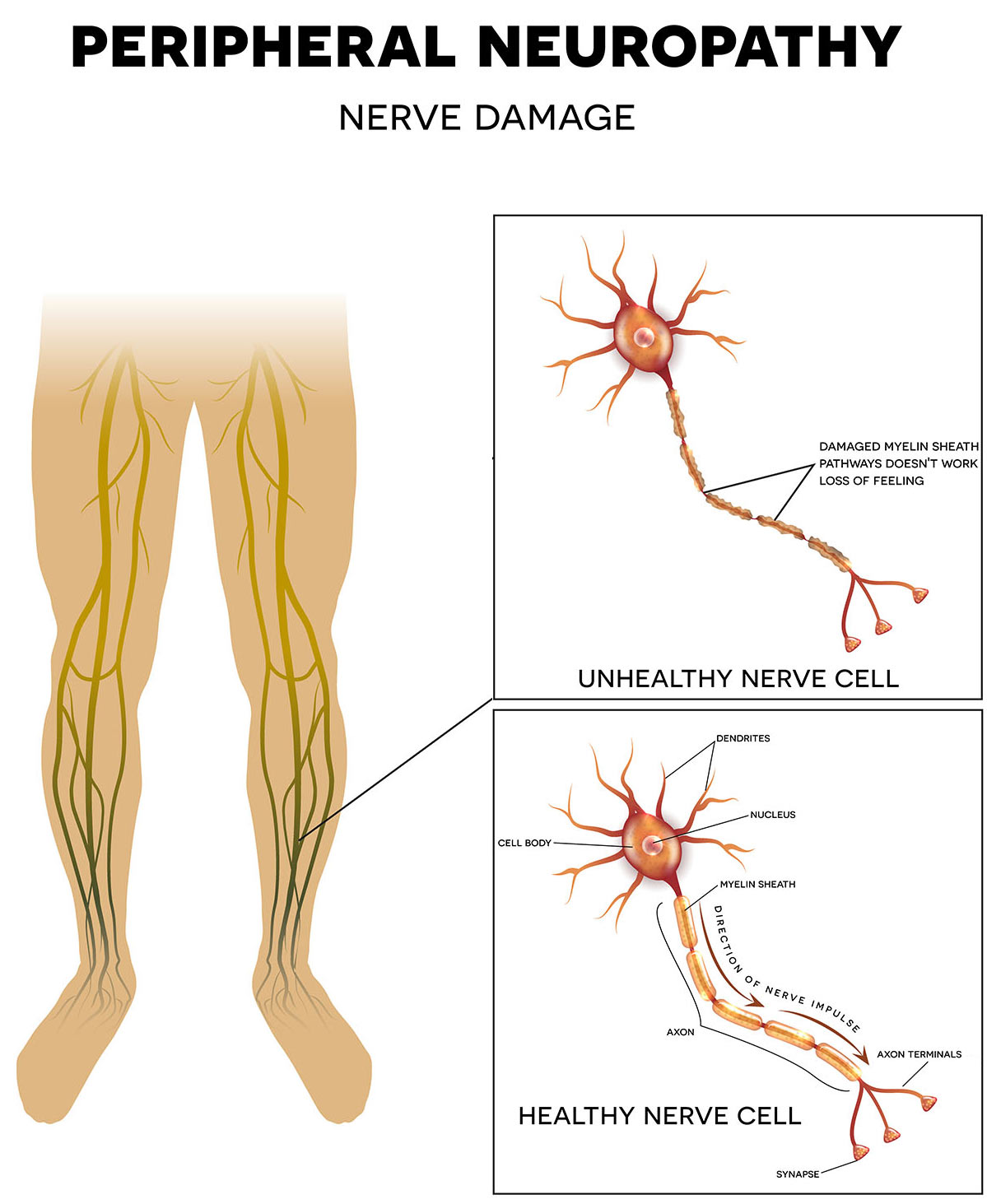 sensory nerve damage